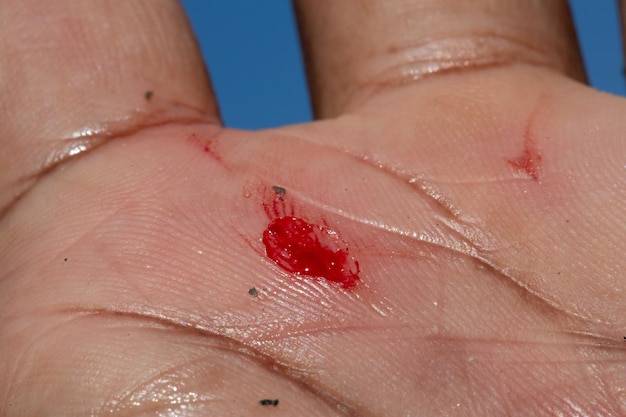 Jak działa Keloptin krem na wybroczyny blizny i krwiaki?