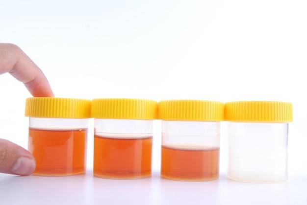 Jak prawidłowo używać pojemnika jałowego na mocz 120 ml?